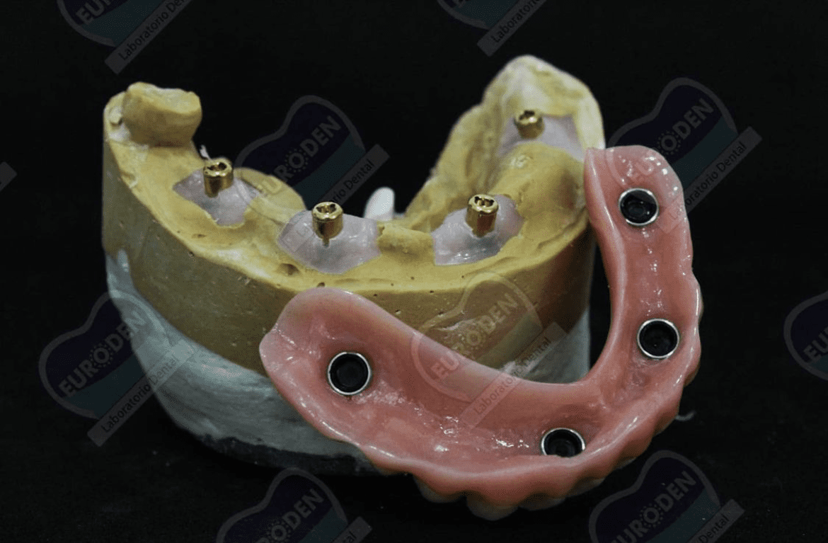 protesis dental 2